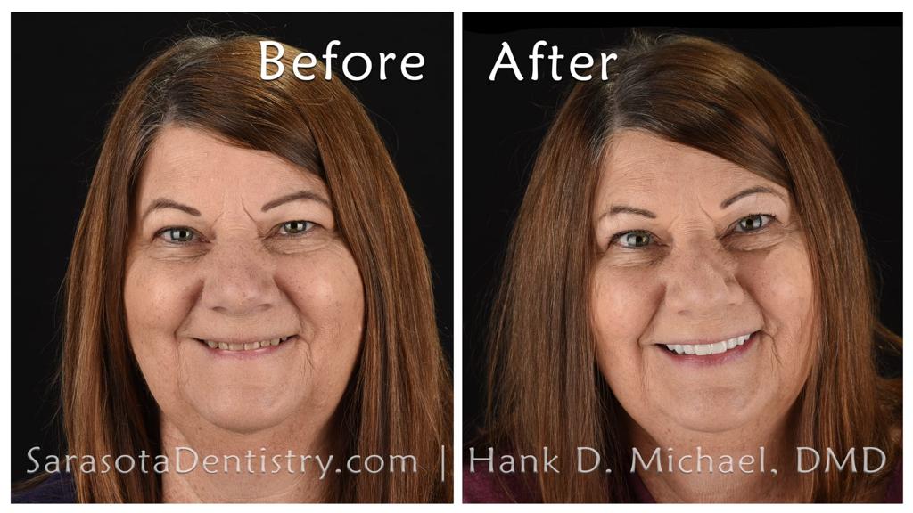 Dental rehabilitation with crowns — before and after