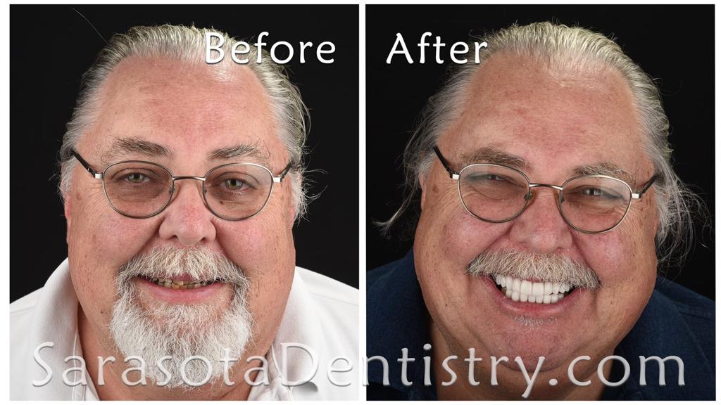 Extreme smile makeover — before and after