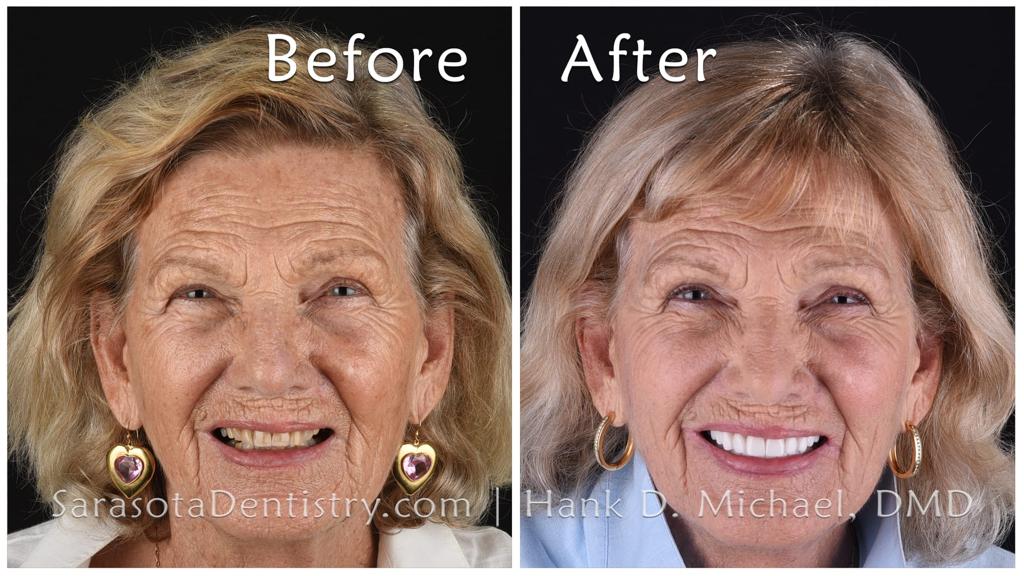 Full-mouth dental implants and crowns — before and after