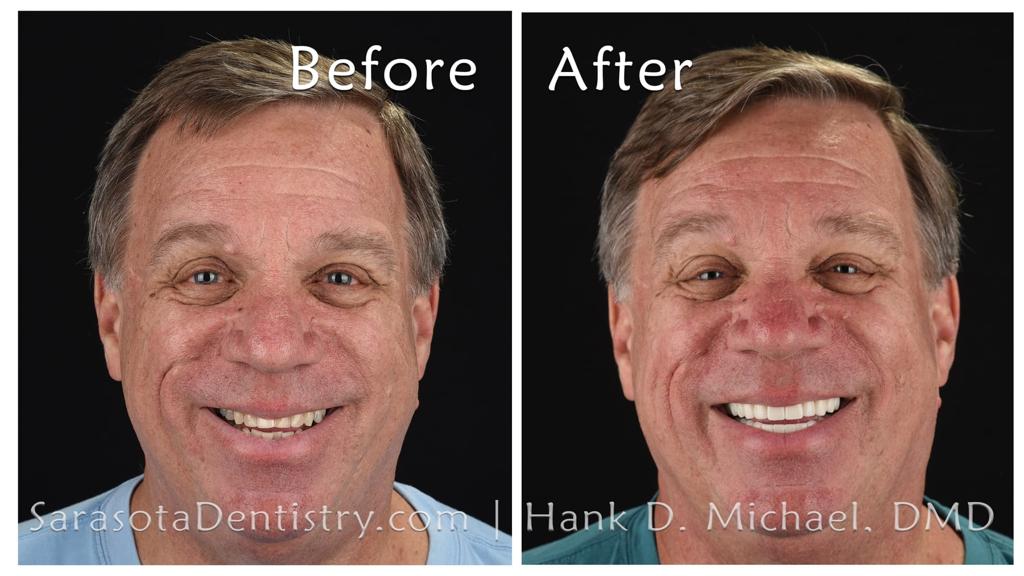 Full-mouth smile makeover — before and after