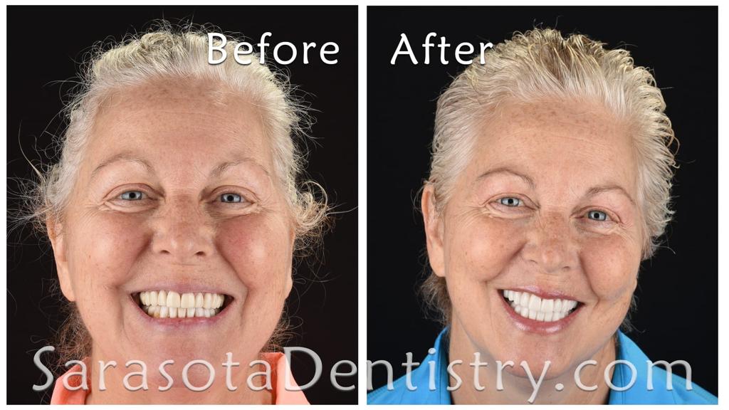 Full-mouth porcelain crowns rehabilitation — before and after