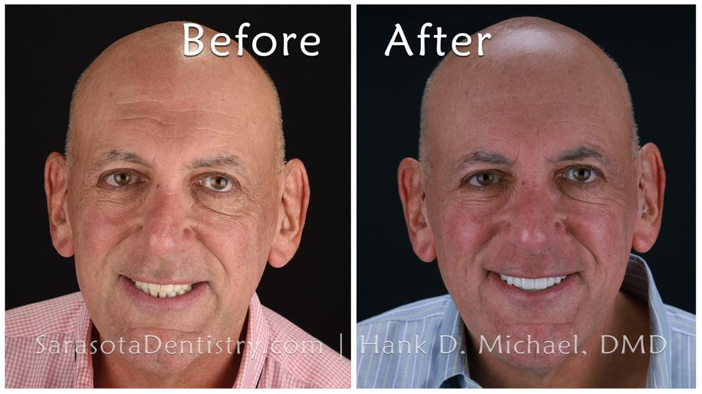 Smile makeover with crowns — before and after