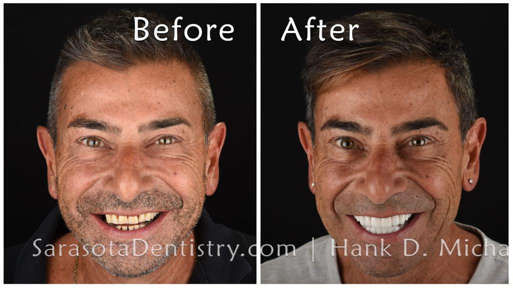 Smile makeover with porcelain crowns — before and after