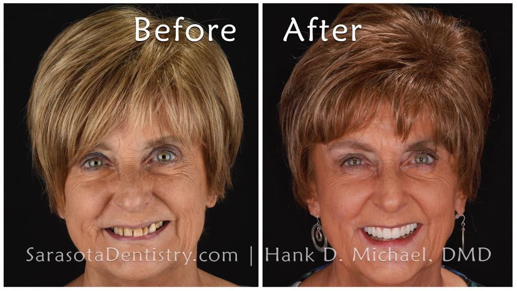 Upper full-arch dental implants — before and after