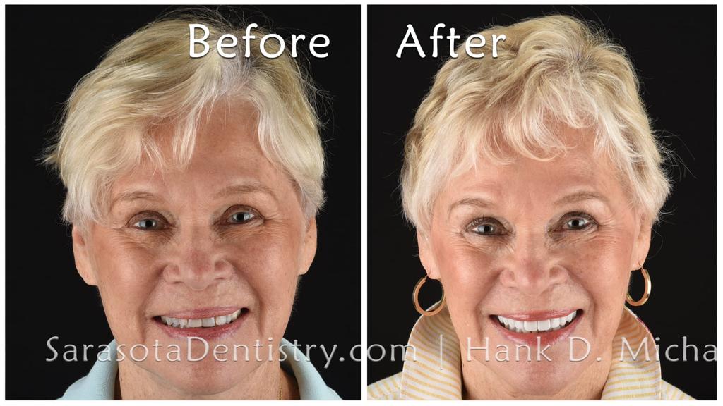 Upper porcelain crowns smile makeover — before and after