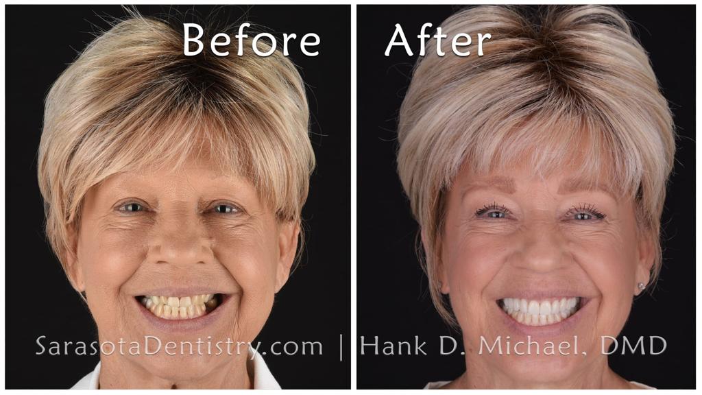 Zirconia cosmetic smile makeover — before and after
