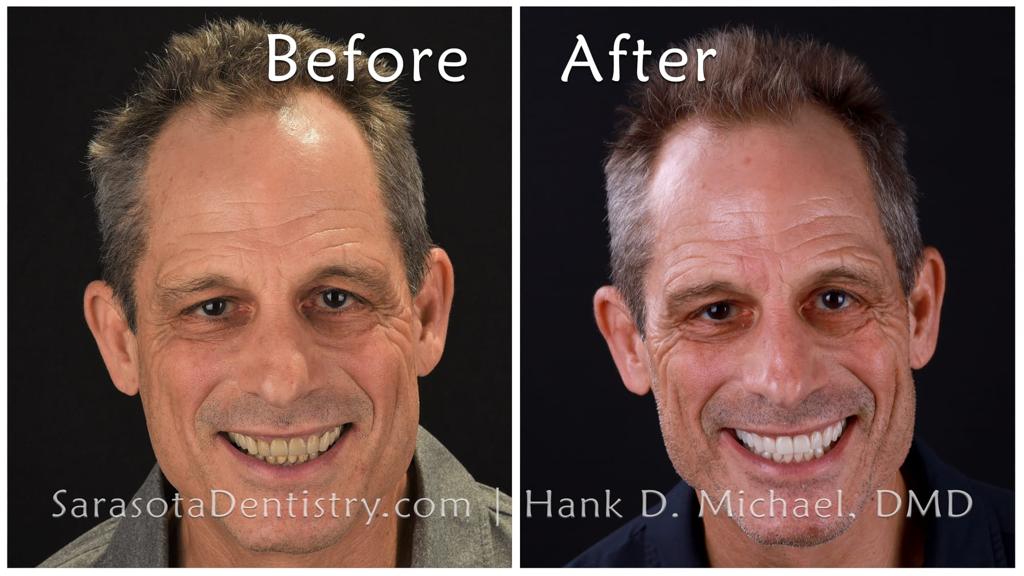 Zirconia crowns smile makeover — before and after