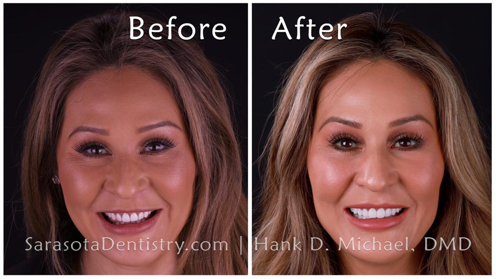 Zirconia crowns smile makeover — before and after