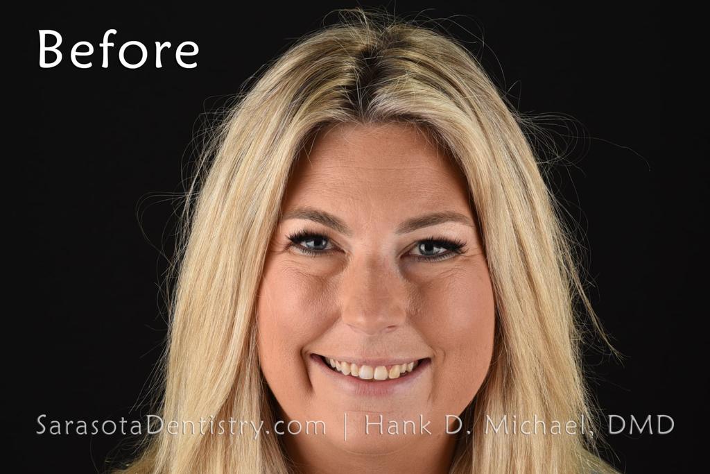 Extreme Smile Makeover with Porcelain Crowns — view 7