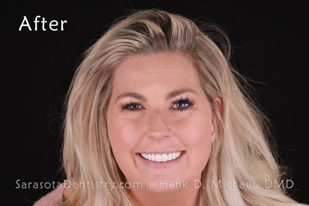 Extreme Smile Makeover with Porcelain Crowns — view 8