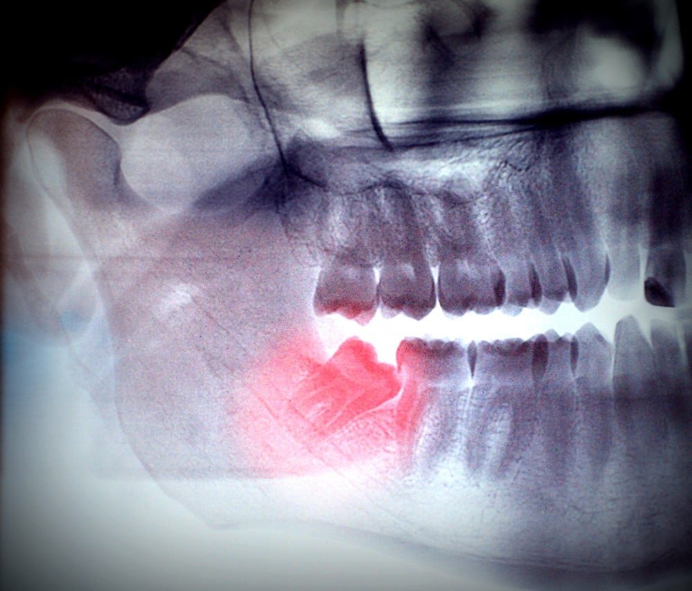 when can i chew tobacco after wisdom teeth removal Smoking tooth Smoking After Wisdom Teeth Removal: