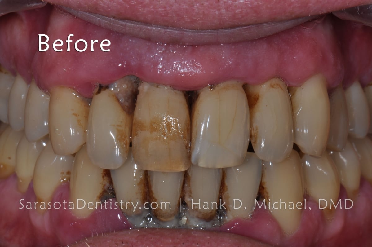 cigarette tar removal from teeth How to Remove Stains and Buildup How to Remove Smoking Stains