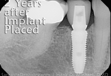 2 years post dental implant procedure x-ray