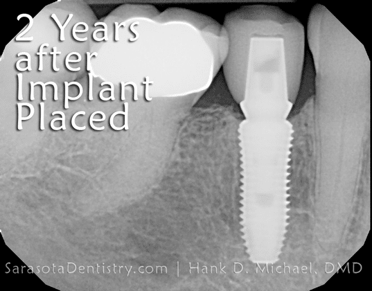 2 years post dental implant procedure x-ray