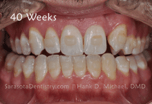 40 Weeks Dental Treatment Pic Results