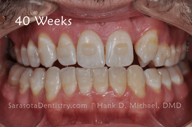 40 Weeks Dental Treatment Pic Results