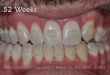 52 Weeks Dental Treatment Results