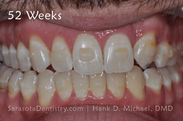 52 Weeks Dental Treatment Results