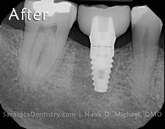 After Dental Implant X-Ray