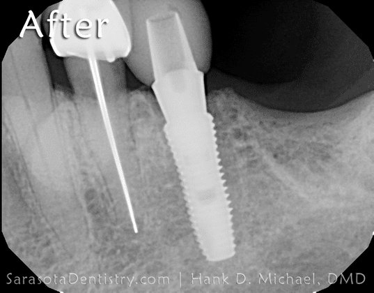 after dental implant procedure x-ray
