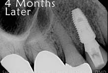 4 months after dental implant procedure