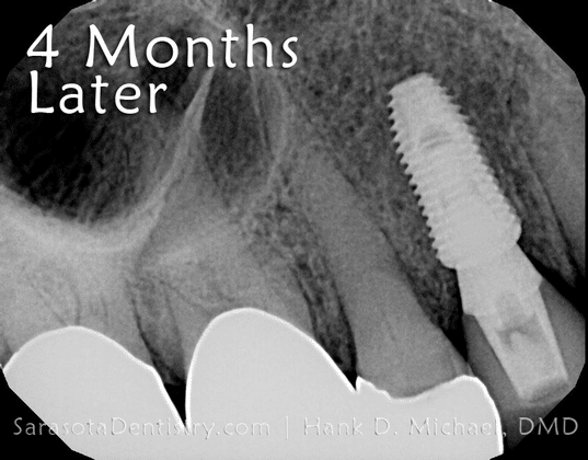 4 months after dental implant procedure