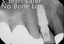 3 years after dental implant procedure