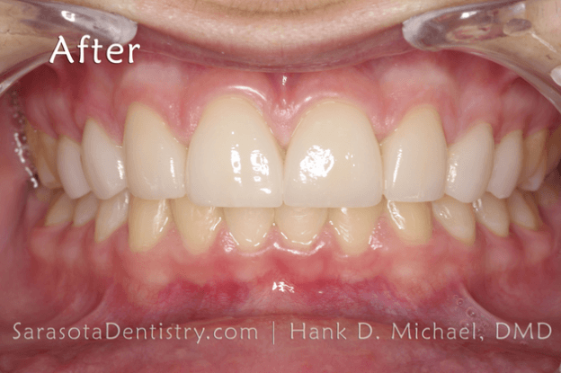 After Dental Treatment at Sarasota Dentistry Pic