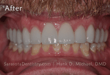 After Pic of Dental Care at Sarasota Dentistry