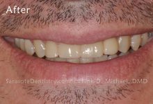 After Pic of Dental Care from Sarasota Dentistry