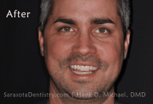 After Dental Treatment with Sarasota Dentistry 2