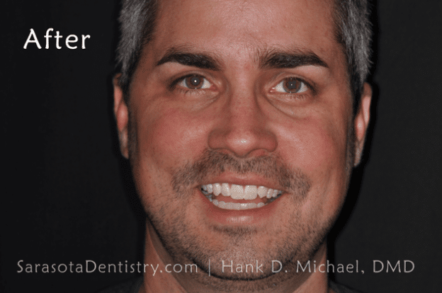 After Dental Treatment with Sarasota Dentistry 2