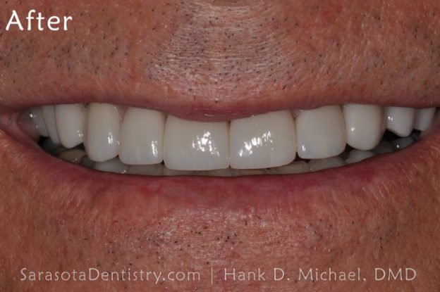 After Dental Care with Sarasota Dentistry