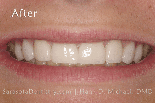 Gallery After Dental Treatment at Sarasota Dentistry