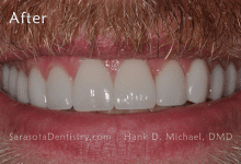 After Pic of Dental Treatment with Sarasota Dentistry