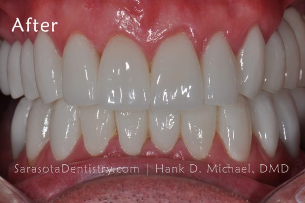 After Dental Care Pic from Sarasota Dentistry