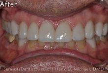 After Dental Treatment with Sarasota Dentistry