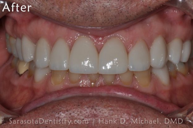 After Dental Treatment with Sarasota Dentistry