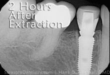 2 hours after tooth extraction x-ray