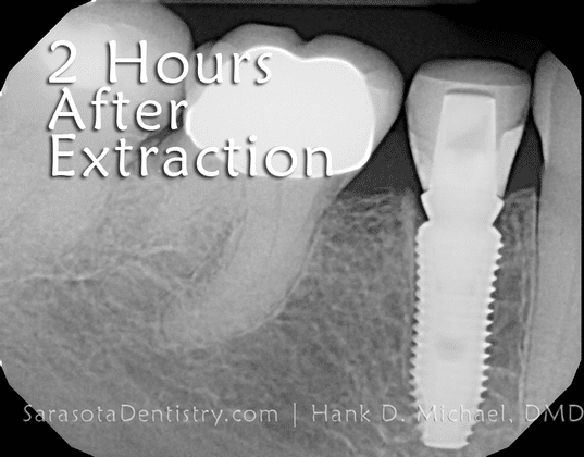 2 hours after tooth extraction x-ray
