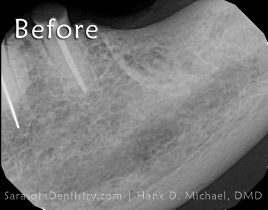 before dental implant procedure x-ray