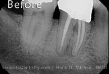 Before Dental Care x-Ray