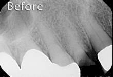 Before dental implants at Sarasota Dentistry