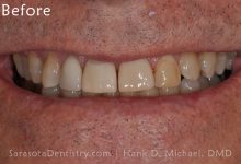 Before Dental Care with Sarasota Dentistry