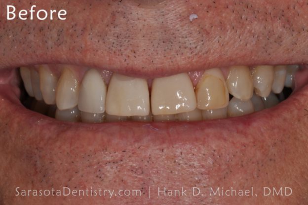 Before Dental Care with Sarasota Dentistry