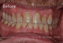 Before Pic of Dental Care from Sarasota Dentistry