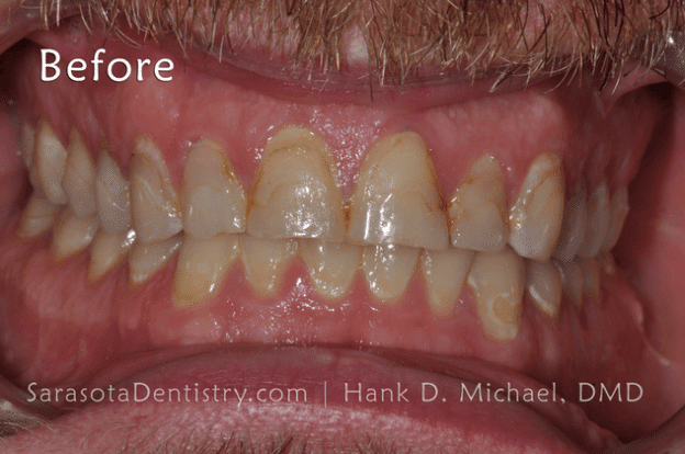 Before Pic of Dental Care from Sarasota Dentistry