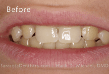 Before Dental Treatment at Sarasota Dentistry pic