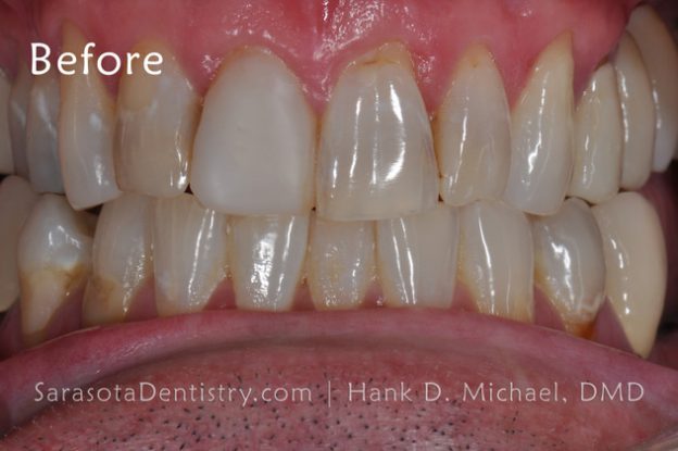 Before Pic of Dental treatment at Sarasota Dentistry