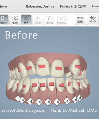 3D Dental Scan Image Before Treatment